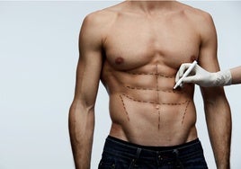 Lipoescultura de alta definición, la técnica para eliminar la grasa y definir los músculos